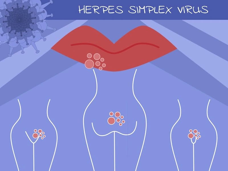 Herpes Genital: Pruebas de Sangre y Análisis de Lesiones