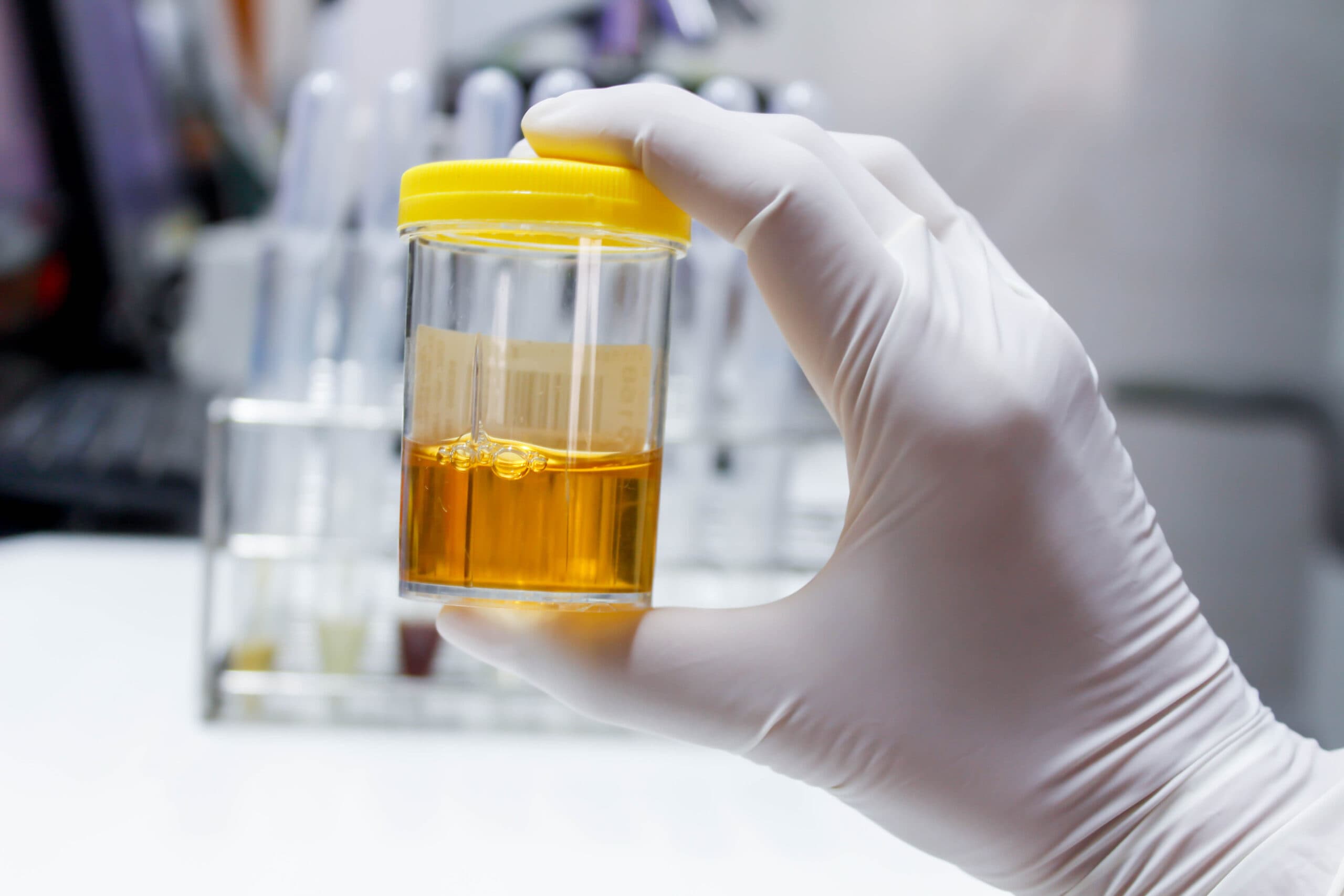 La Importancia del Diagnóstico de ITS: Avances en la Detección mediante PCR